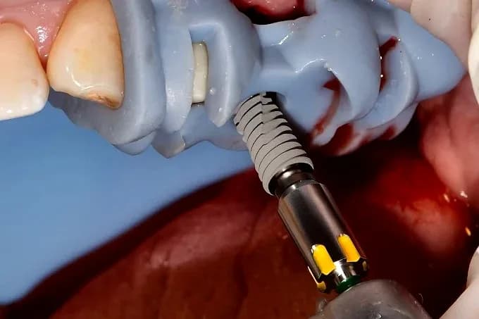 Implantes Dentales